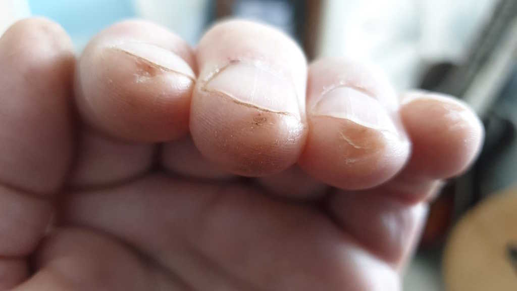 Sore fingers from playing guitar