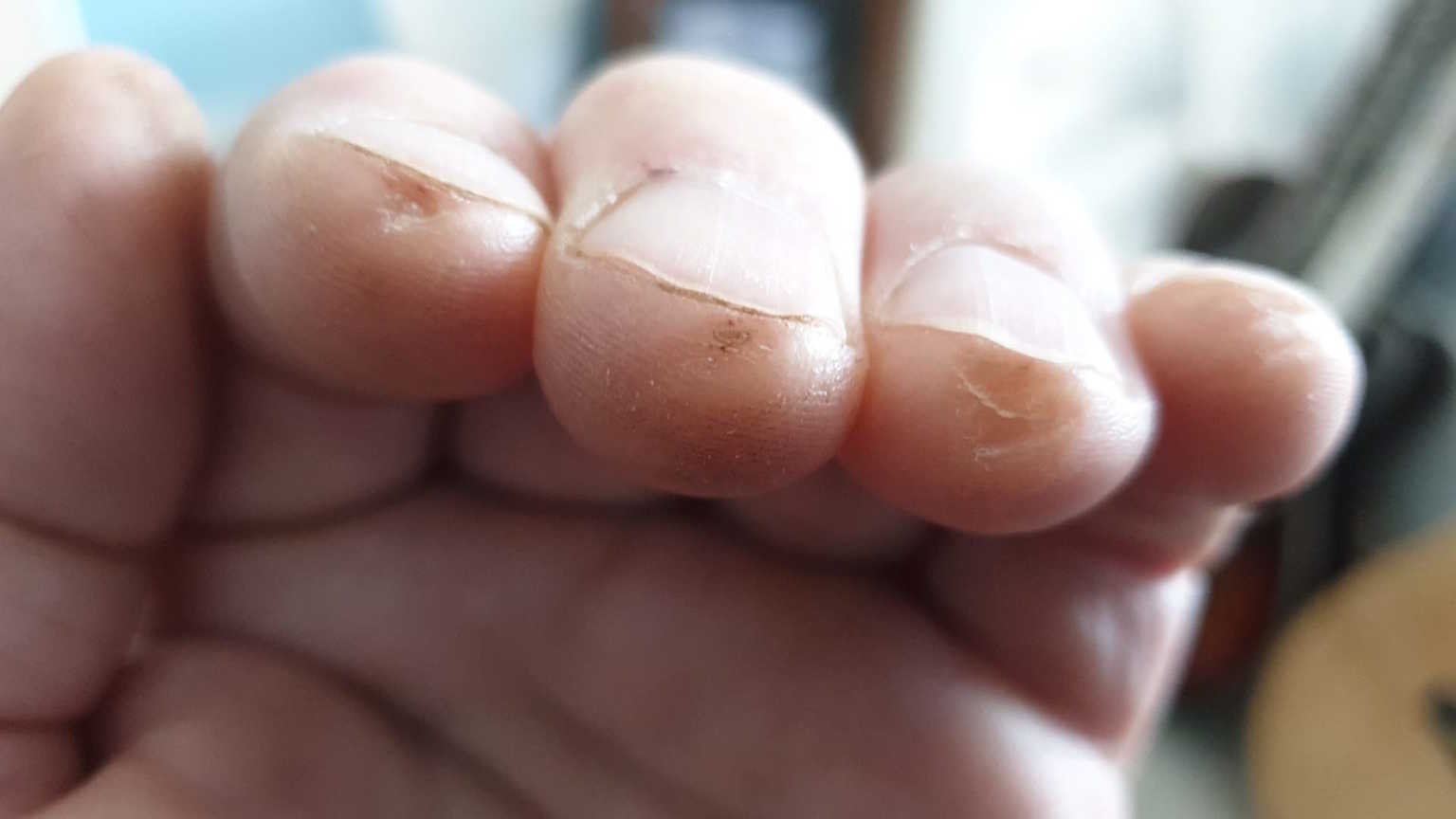Sore fingers from playing guitar The IOM Process